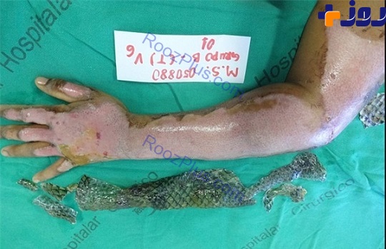 درمان سوختگی‌ با پوست ماهی! +تصاویر