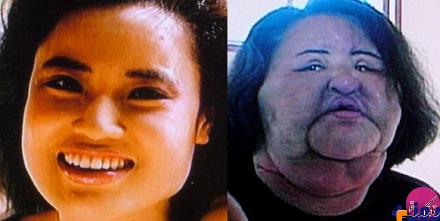 زنانی که با جراحی پلاستیک زشت شدند/ عکس