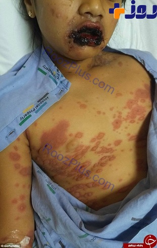 بیماری نادری که کودک 9 ساله را تبدیل به زامبی کرد +عکس