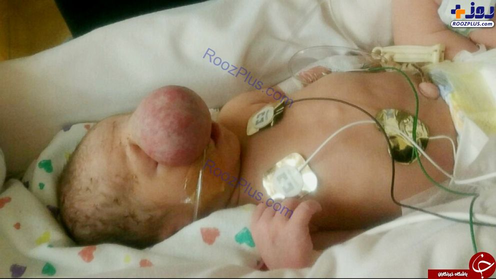 جراحی کودکی که مغزش در بین چشم هایش رشد کرد! +تصاویر