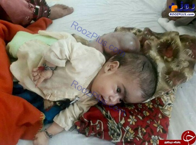 بیماری عجیب و غریب کودک پاکستانی! +تصاویر