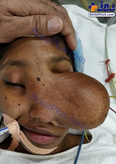 تومور وحشتناک و بدشکل بینی دختر 15 ساله+تصاویر