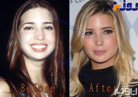 «ایوانکا ترامپ» قبل و بعد از عمل زیبایی +تصاویر