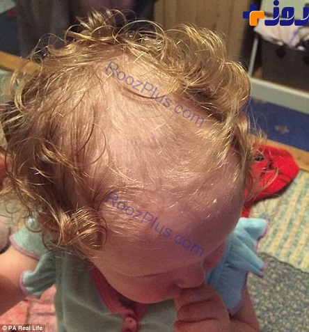 کوچکترین فرد مبتلا به وسواس اجباری کندن موی سر در دنیا! +تصاویر