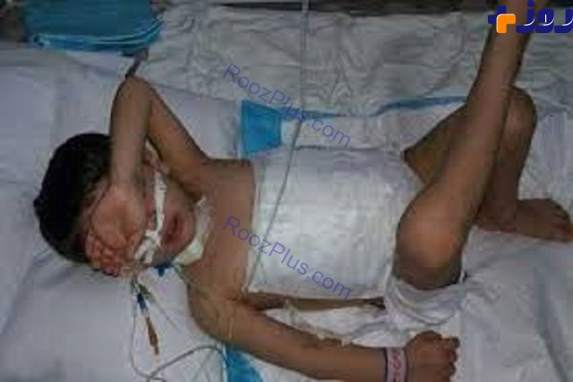 کودک 5 ساله که شکمش توسط گرگ دریده شده بود، درگذشت+ عکس