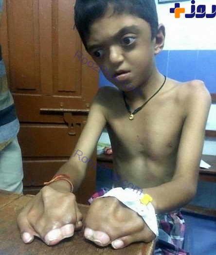 بیماری نادر که تمامی انگشتان کودک را به هم چسبانده است! +تصاویر