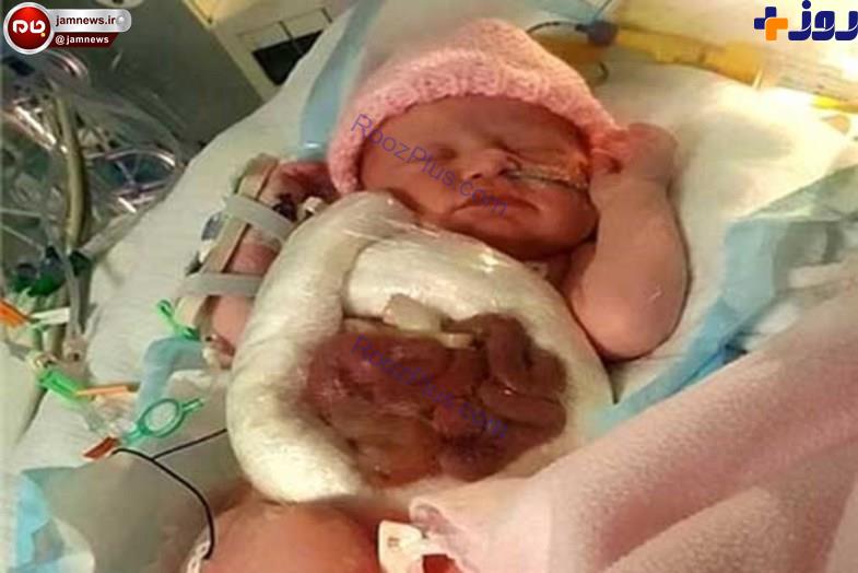روده های این نوزاد خارج از شکمش است+عکس