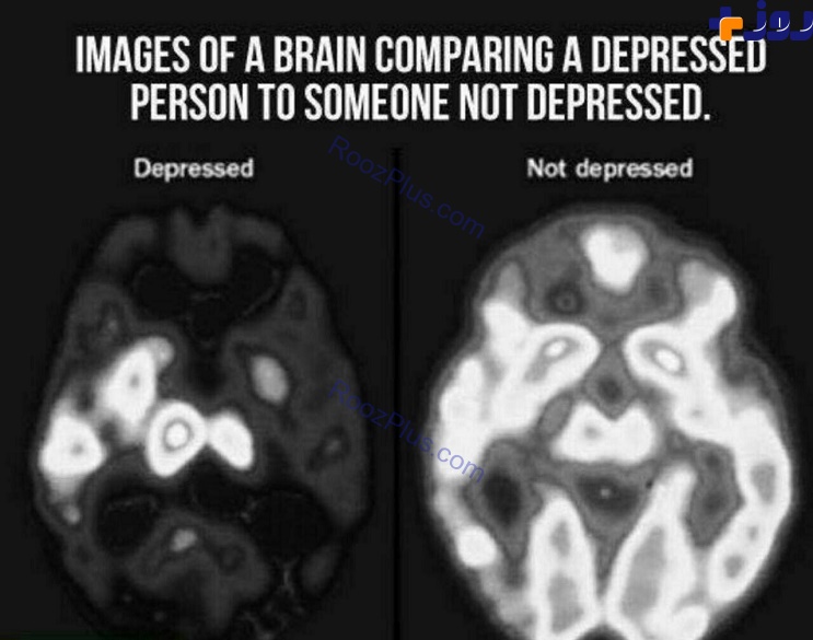 عکسی عجیب از مقایسه مغز دو انسان افسرده و خوشحال