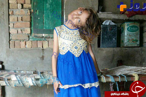 انحراف عجیب گردن دختر پاکستانی ورنجی که تحمل می کند! +تصاویر