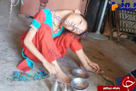انحراف عجیب گردن دختر پاکستانی ورنجی که تحمل می کند! +تصاویر