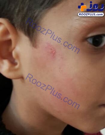 حواشی انتشار تصویر دانش‌آموزی با صورت زخمی در فضای مجازی/عکس