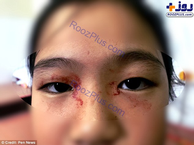 بیماری نادر تعریق خونی دختر ۱۱ ساله+عکس