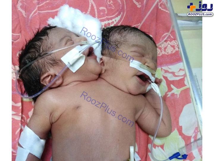 عکس/تولد نوزادی با ۲ سر و ۵ دست و پا در مصر!