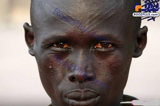 شیوع بیماری مرموز و کشنده در اتیوپی +عکس