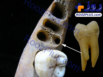 دندان عجیب و قدیمی که سه ریشه دارد! +عکس