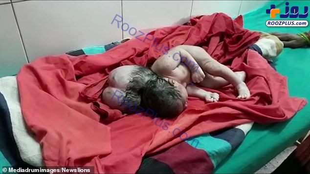 تولد یک نوزاد با ۳ سر !+تصاویر