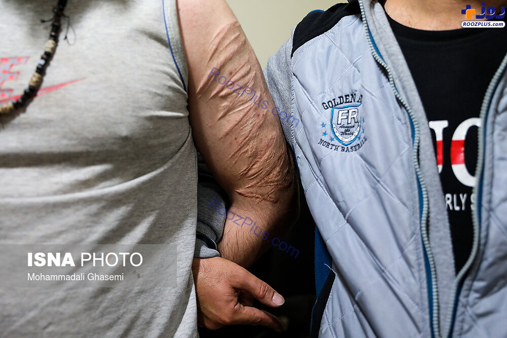 آثار درگیری های شدید بر روی بازوی فروشنده مواد مخدر/عکس