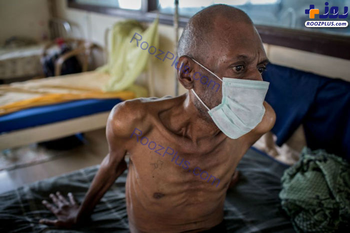۱۰ بیماری انسانی هولناک و مرگبار تاریخ+ تصاویر