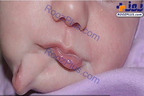 تولد عجیب نوزاد دختر با دو دهان+عکس