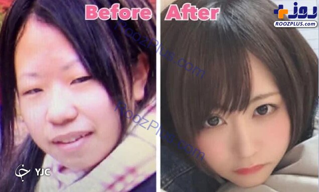 عکس/ حیرت کاربران از تغییر چهر‌ه این د‌ختر پس از جراحی پلاستیک