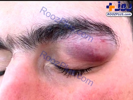 حمله همراه بیمار کرونایی با چاقو به چشمان یک پزشک ! /عکس