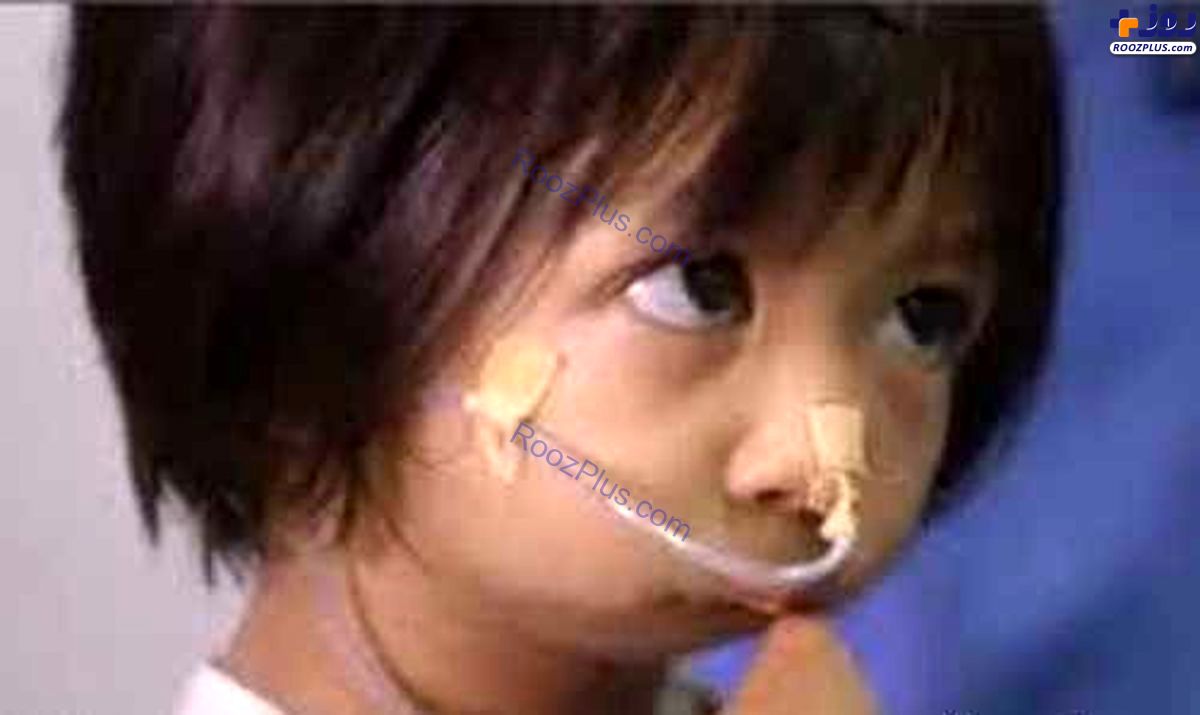 خبر عجیب ؛ ساختن دهان برای دختر بچه بدون دهان! +عکس