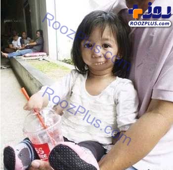 خبر عجیب ؛ ساختن دهان برای دختر بچه بدون دهان! +عکس