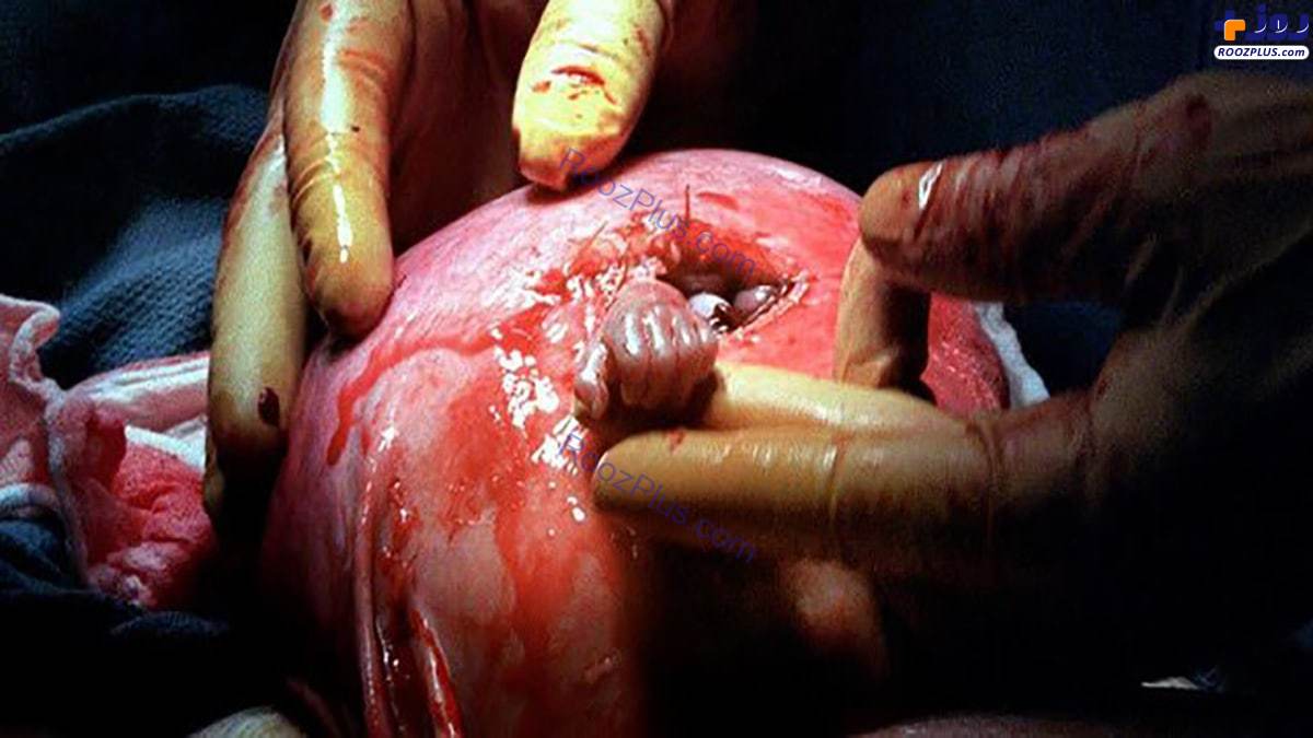 جنینی که پیش از تولد دست جراحش را فشرد +عکس