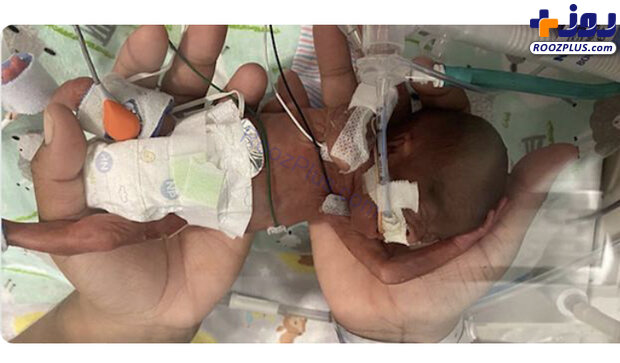 نارس ترین نوزاد دنیا که در ۲۱ هفتگی متولد شده! +عکس